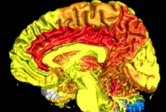 Imagen cerebral de una mujer muestra la mayor actividad por flujo sanguíneo (áreas rojizas). Foto cortesía Journal of Alzheimer Disease