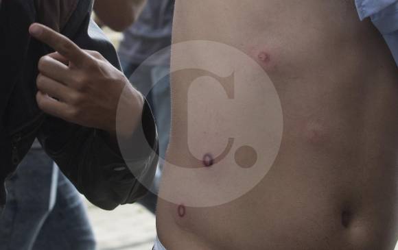 Algunos proyectiles disparados por la Policía terminaron los cuerpos de los estudiantes. FOTO MANUEL SALDARRIAGA Algunos proyectiles disparados por la Policía terminaron los cuerpos de los estudiantes. FOTO MANUEL SALDARRIAGA