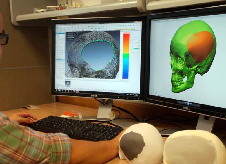 Innmetec podrá distribuir prótesis de articulación temporomandibular y un implante para reemplazo vertebral. Personas con afectaciones en esa parte del cuerpo podrán usarlas. FOTO Cortesía eafit