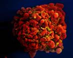 Un tumor maligno que ataca el cáncer de páncreas y que tiene una letalidad del 88 %. FOTO: GETTY
