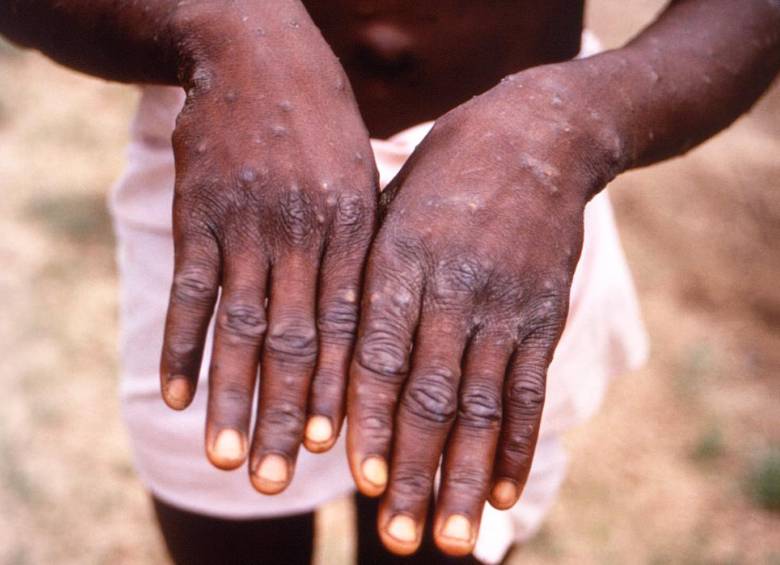 La viruela del mono, a diferencia del coronavirus, es una enfermedad conocida y hay experiencias previas de brotes. FOTO getty