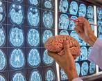 El hemisferio cerebral derecho va ligado a la creatividad y el izquierdo a lógica ¿Es mito?