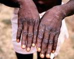En Colombia se han detectado 10 casos de viruela del mono. FOTO GETTY