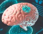 Los chips que propone Elon Musk se implantarán con cirugía robótica. FOTO: SSTOCK