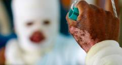 El drama de los quemados con pólvora no solo golpea adultos, en un alto porcentaje las víctimas son niños. FOTO MANUEL SALDARRIAGA