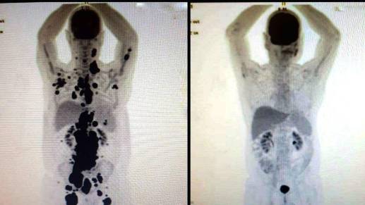 La primera imagen es del 6 del marzo y la segunda del 24 de abril. Hay total remisión del cáncer. FOTO: @Paulocfperegrino