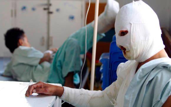 En el informe final del Instituto Nacional de Salud se registraron 1.174 quemados en el período 2021-2022 en Colombia. FOTO: COLPRENSA.