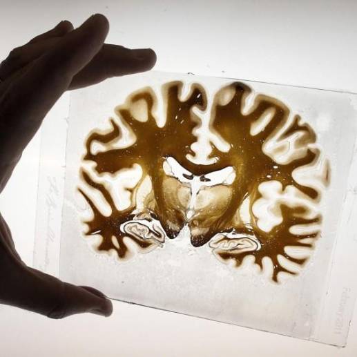 Al parecer son nueve zonas del cerebro que se ven afectadas por la hipertensión y puede aumentar la posibilidad del desarrollo de demencia. FOTO: Agencias