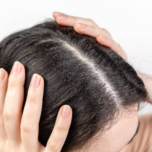 La prevalencia de la caspa oscila entre el 25 y 30 %, según dermatólogos consultados. FOTO: GETTY