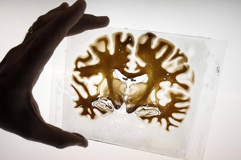 Al parecer son nueve zonas del cerebro que se ven afectadas por la hipertensión y puede aumentar la posibilidad del desarrollo de demencia. FOTO: Agencias