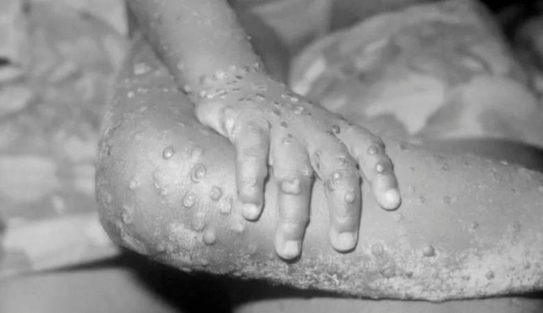 Qué es la viruela del mono, la enfermedad que se extiende en España, Portugal y Reino Unido