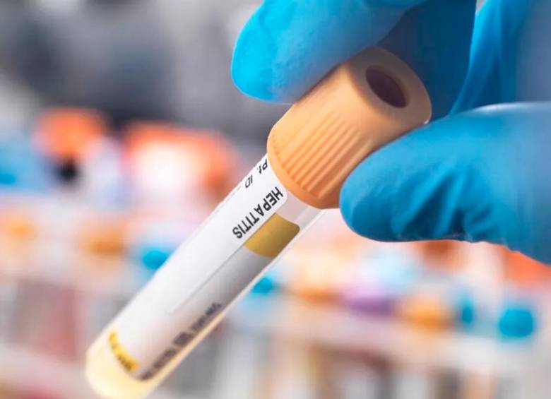 La hepatitis en niños puede provocar vómitos, orina oscura y que la piel se ponga de un tono amarillento. FOTO getty