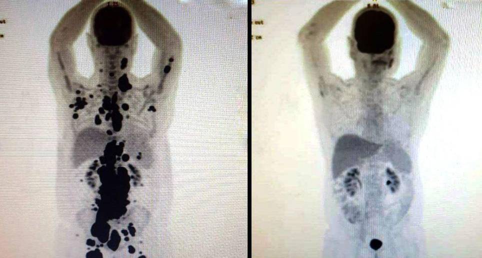 La primera imagen es del 6 del marzo y la segunda del 24 de abril. Hay total remisión del cáncer. FOTO: @Paulocfperegrino