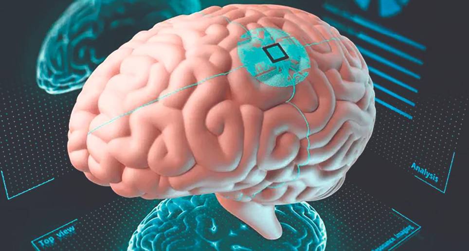 Los chips que propone Elon Musk se implantarán con cirugía robótica. FOTO: SSTOCK