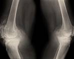 Aunque frecuente en mujeres de edad adulta, la osteoporosis también pueden padecerla los hombres. FOTO sstock