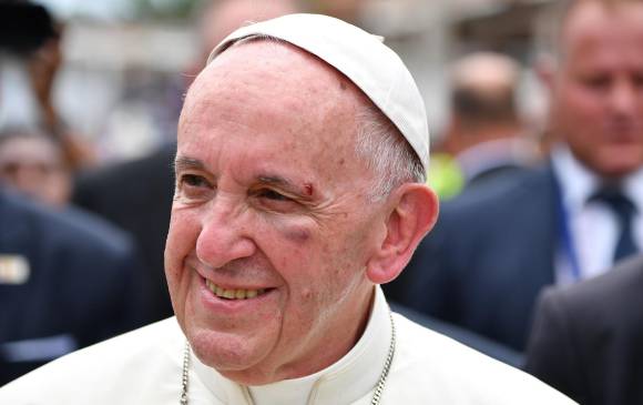 Así quedó el Papa Francisco luego del golpe con el papamóvil. FOTO AFP