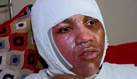 Kyland Clark, de 15 años, tuvo quemaduras de segundo grado por el reto viral ‘Hot Water Challenge’. Foto: Fox59
