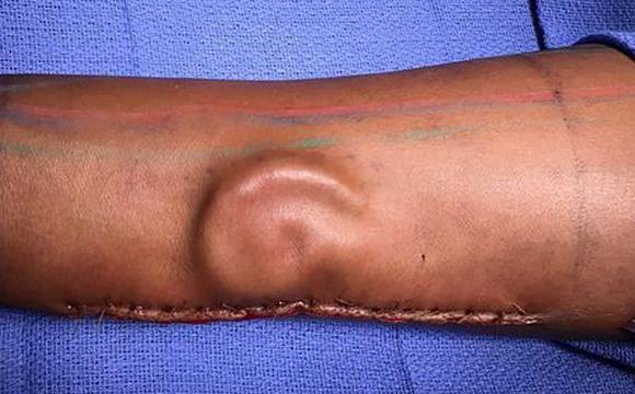 Así lucía la oreja en el antebrazo. Allí formó piel y sistema vascular. Foto US Army