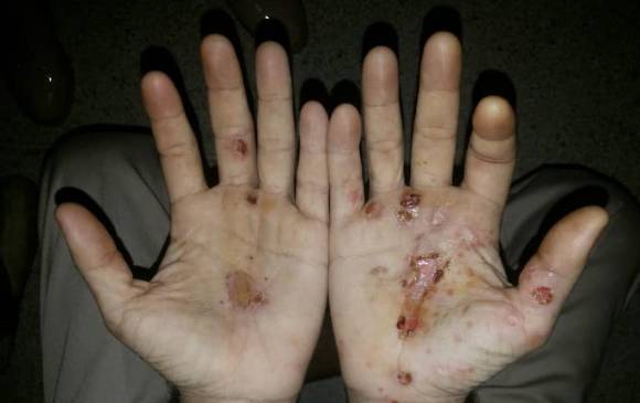 Marcas de posible tortura en centro de reclusión de Venezuela. FOTO: CORTESÍA