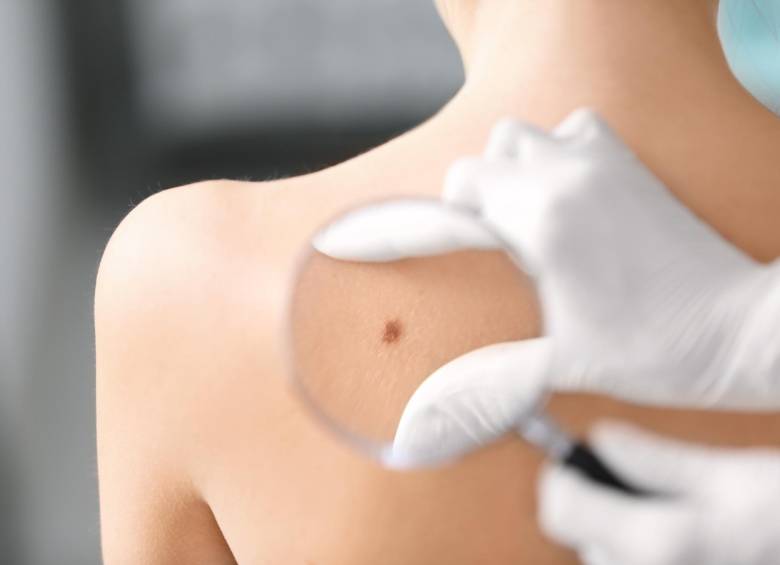 Se debe sospechar un melanoma ante cambios que puedan tener los lunares o ante la aparición de lunares que se vean muy diferentes. FOTO sstock